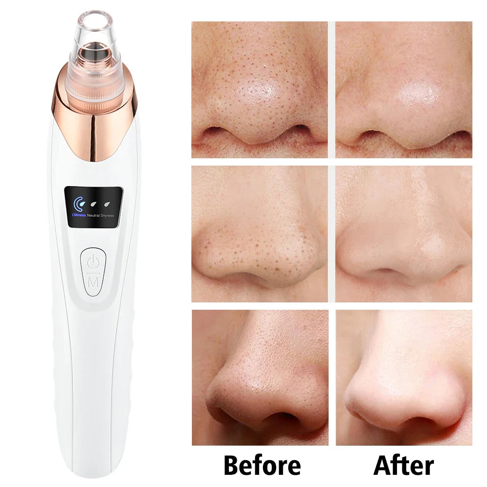 Derma Pore Cleaner Acne Oil Remover Vacuum Face Pore Cleaner Facial Beauty Equipment