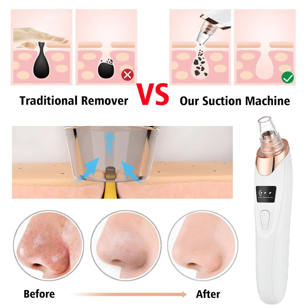 Derma Pore Cleaner Acne Oil Remover Vacuum Face Pore Cleaner Facial Beauty Equipment